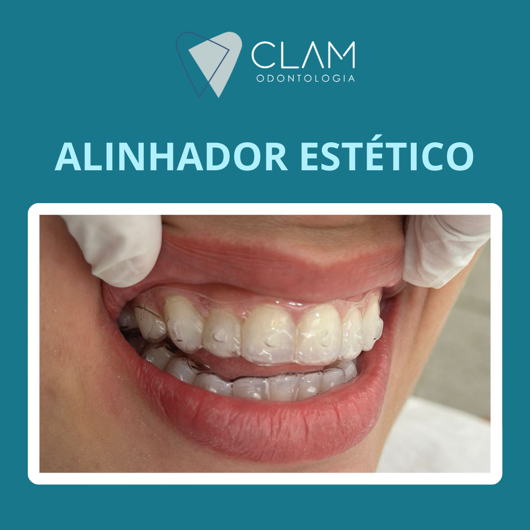 Alinhadores Estéticos
