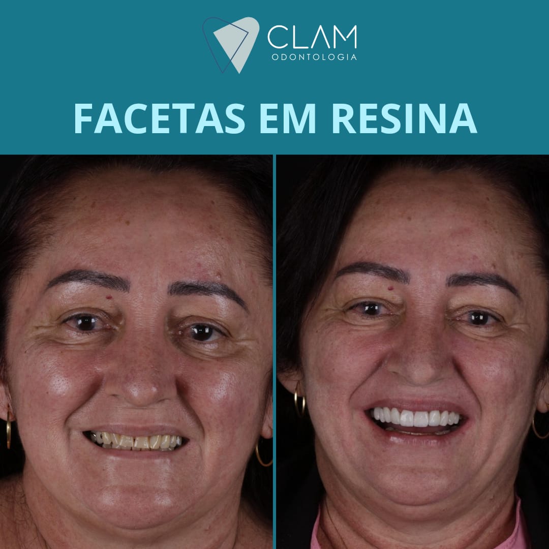 Imagem de Facetas Dentárias